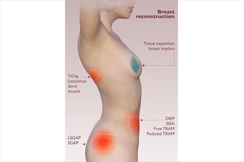Breast Reconstruction-1